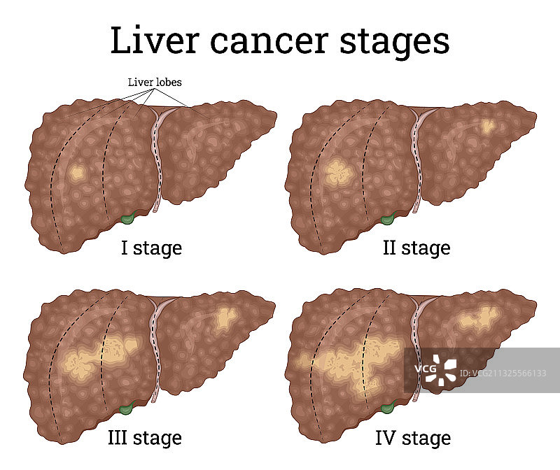 肝癌分期图片素材
