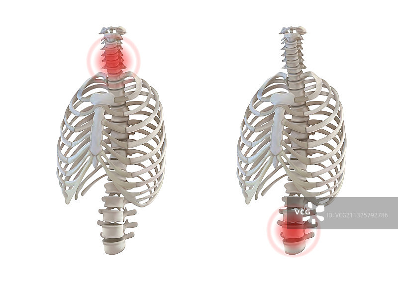 颈部和骨盆的骨质疏松症脊柱图片素材