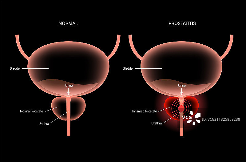 前列腺炎炎症问题图片素材