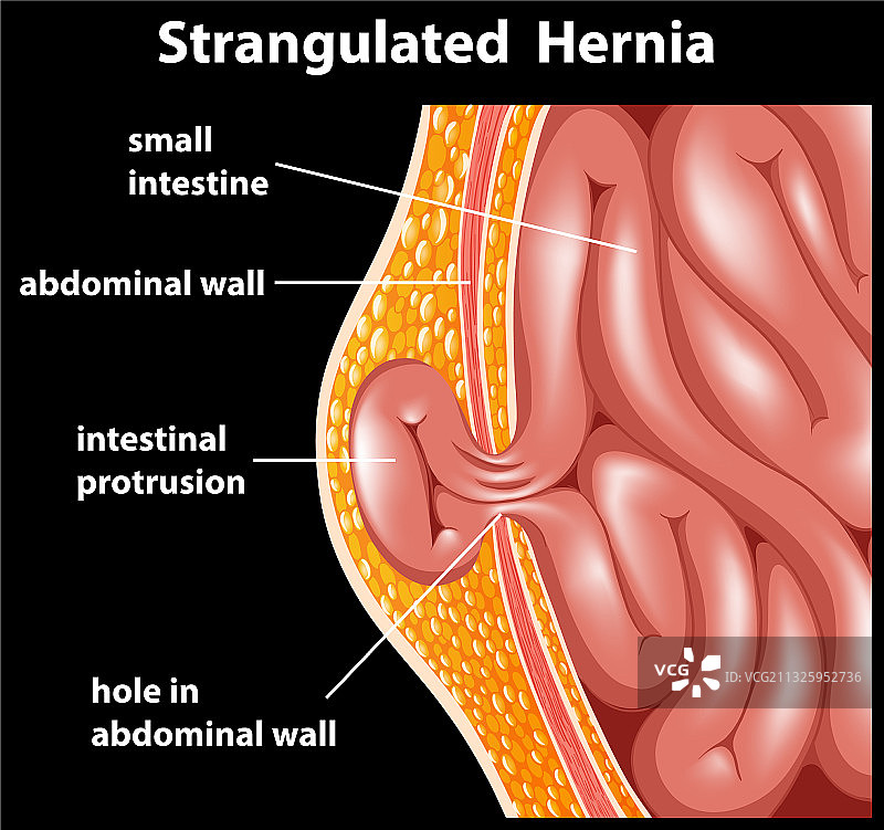 绞窄性疝气图示（教育用途）图片素材