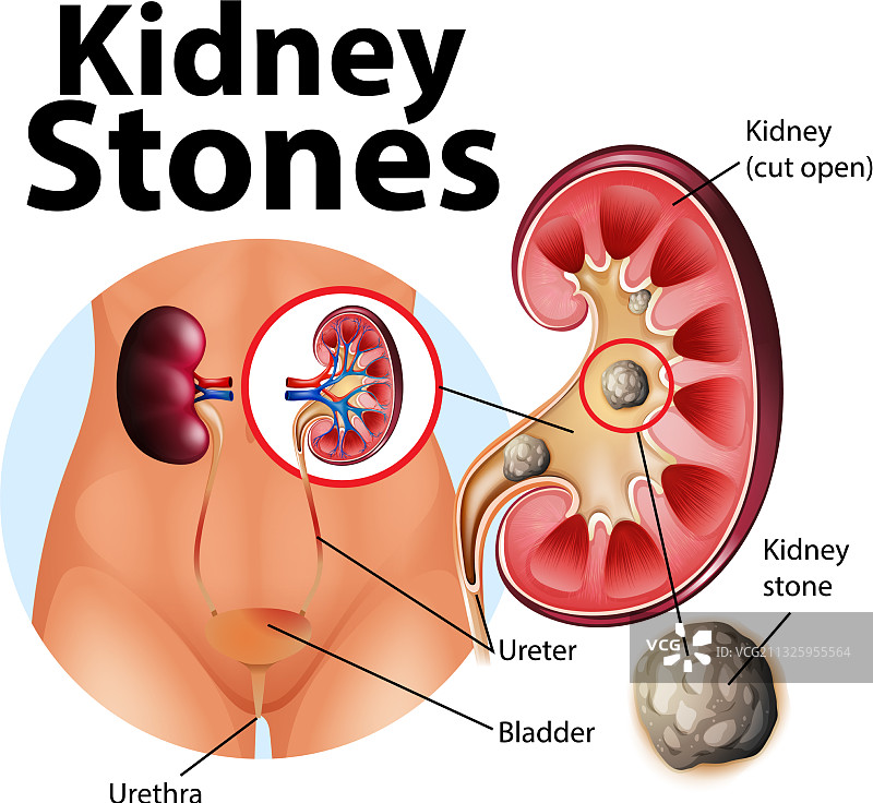 肾结石信息图片素材