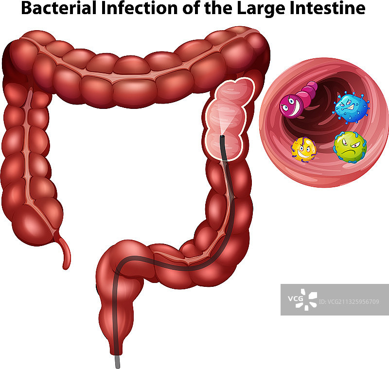 细菌感染大肠图片素材