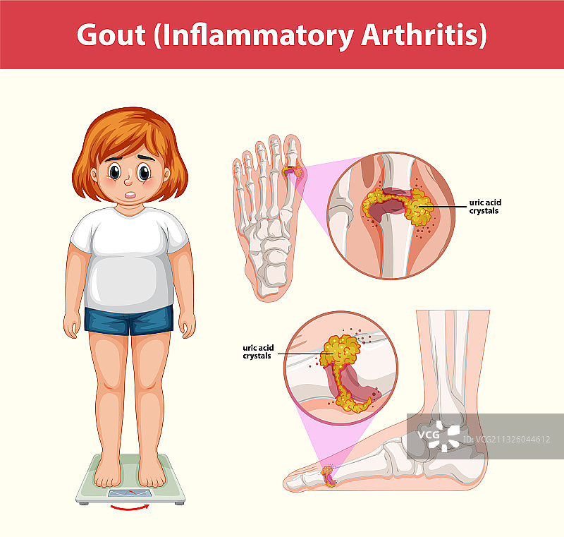 痛风性炎症关节炎医疗信息图片素材