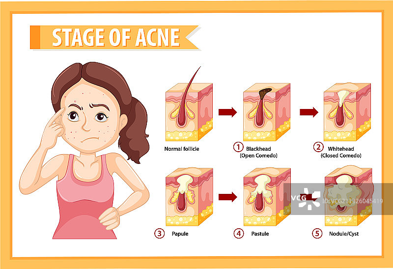 女性的皮肤痤疮解剖阶段图片素材