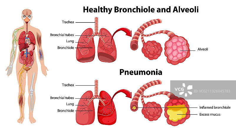 健康与不健康的人类肺部图片素材