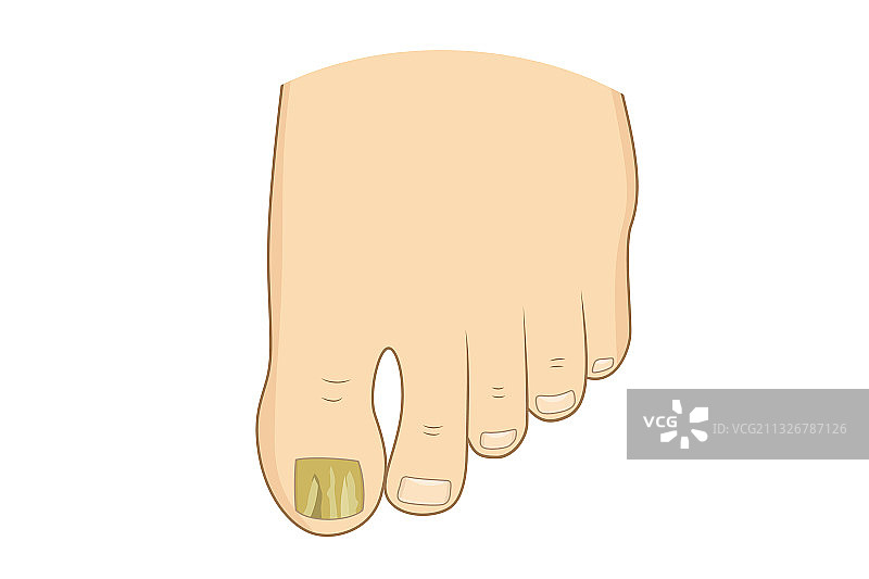 脚趾甲癣图片素材
