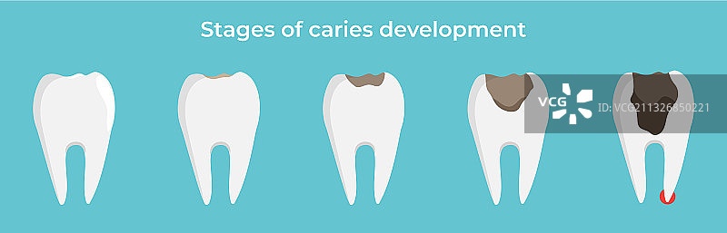 龋齿发展阶段图片素材