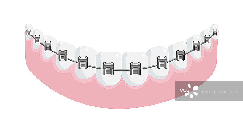 牙龈中直牙上的金属牙套图片素材