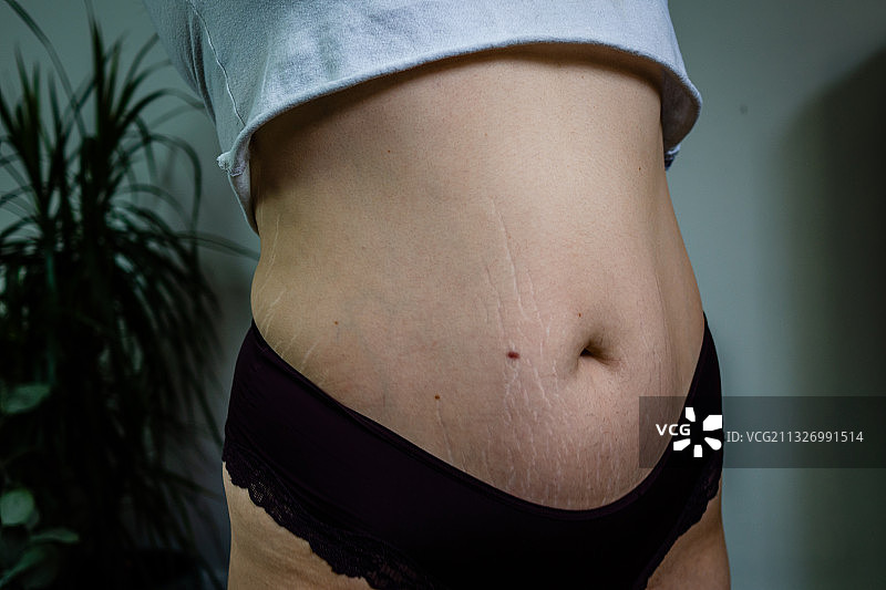 自信年轻女性腹部妊娠纹特写，加拿大多伦多图片素材