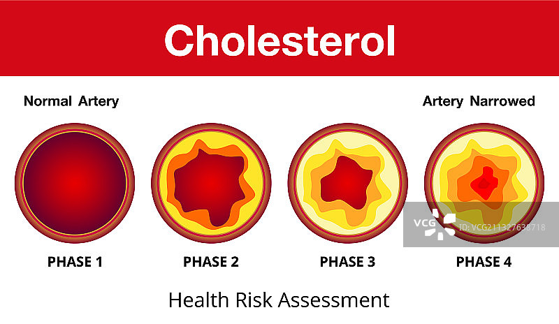 胆固醇在动脉健康风险设计中的作用图片素材