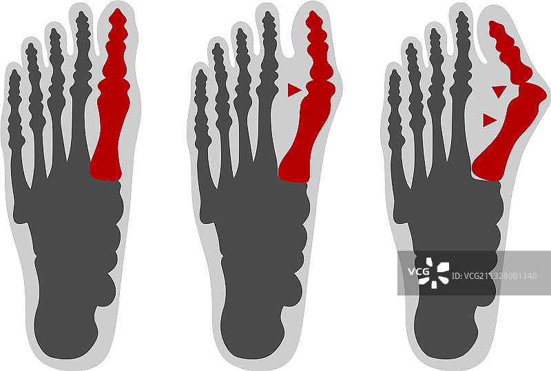 健康的脚和拇外翻畸形图片素材