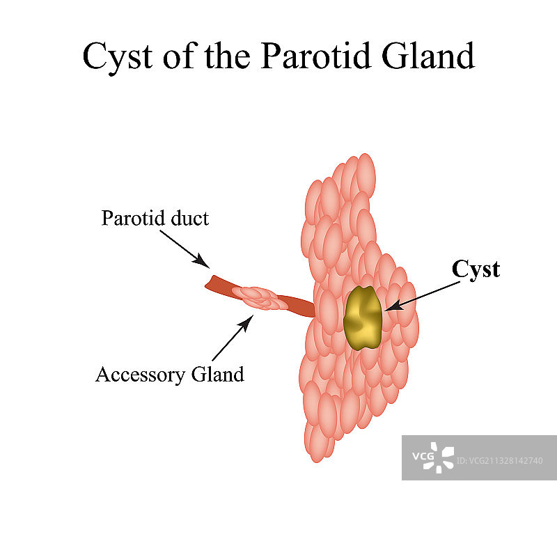 腮腺囊肿结构图片素材