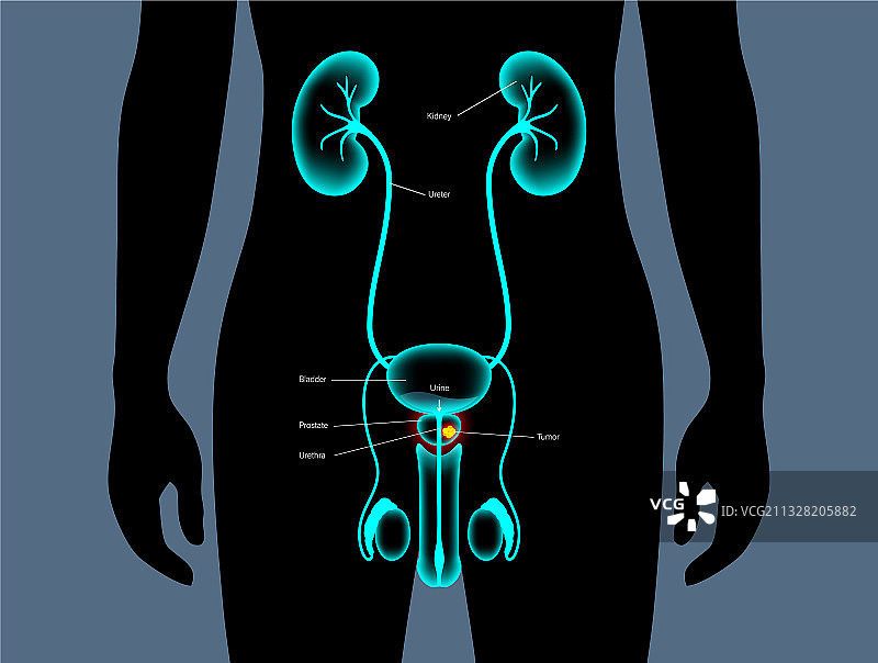 前列腺癌概念图片素材