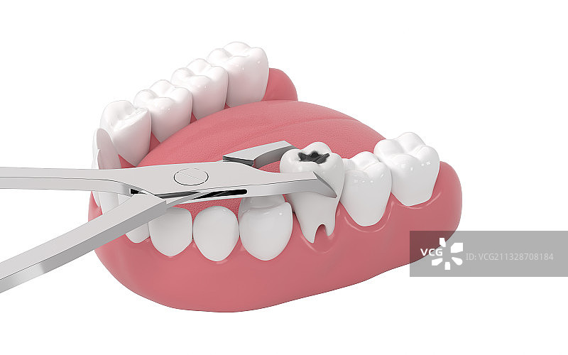 拔除口腔里的蛀牙 3D渲染图片素材
