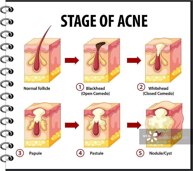 皮肤痤疮解剖阶段图片素材