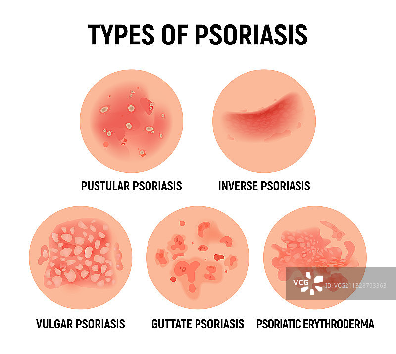手部牛皮癣皮疹感染图片素材