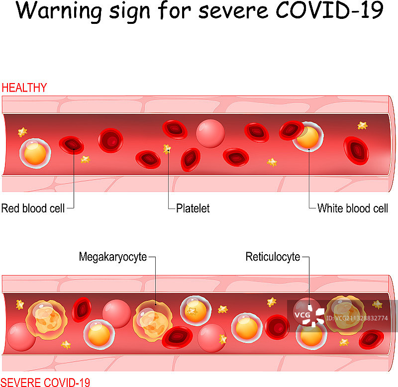 严重急性新冠肺炎警告标志图片素材