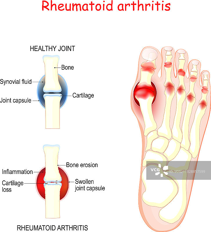人类足部关节中的类风湿性关节炎图片素材