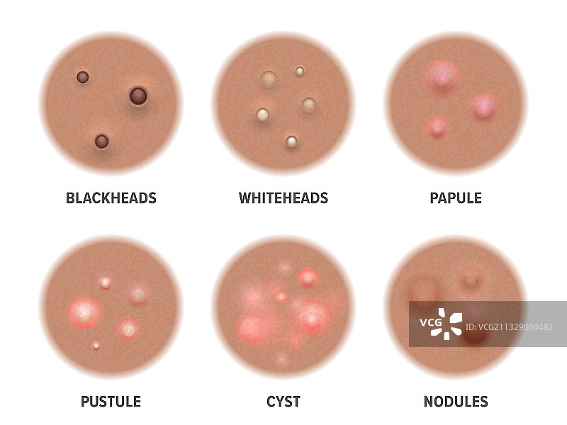 深色皮肤上的痤疮类型和粉刺图片素材