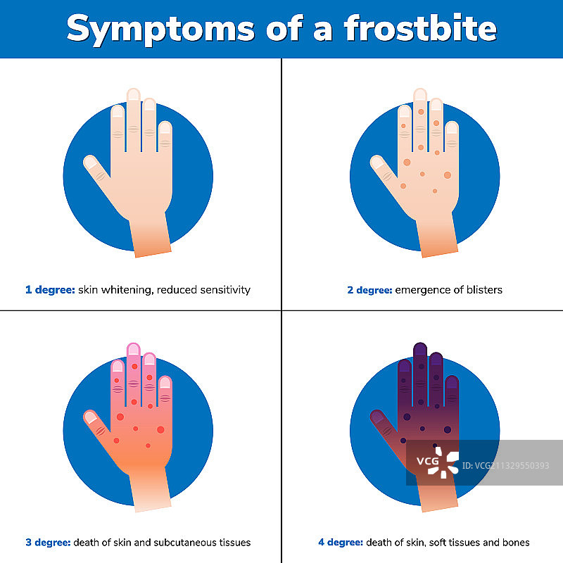 冻伤的4个医疗阶段症状图片素材