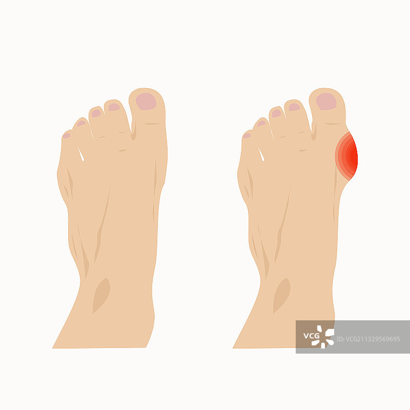 拇外翻足部损伤图片素材