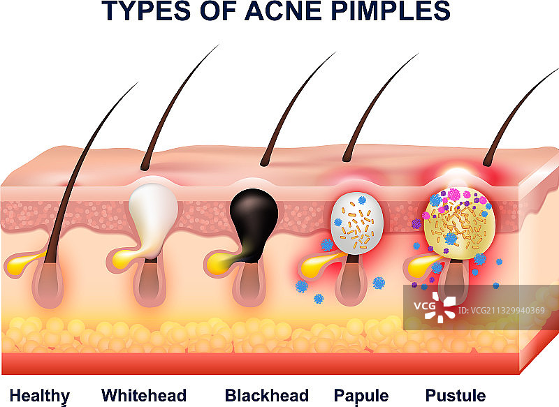 皮肤痤疮解剖结构图片素材