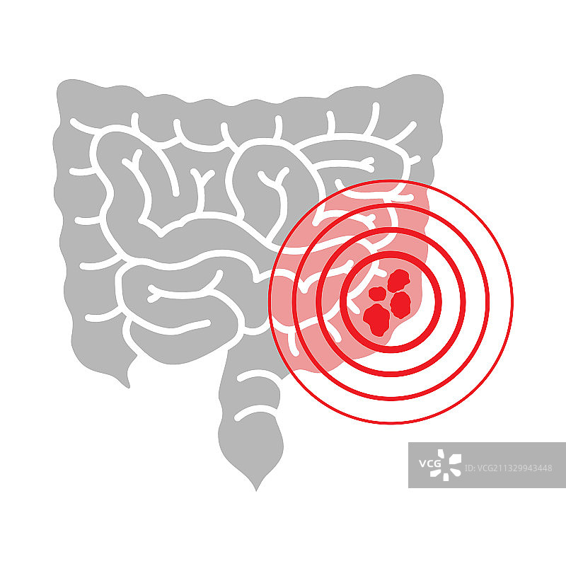 结肠癌——肠道和疼痛圈图片素材