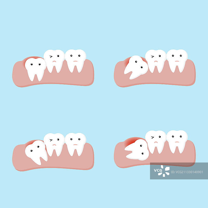 阻生齿或智齿牙科和口腔问题图片素材