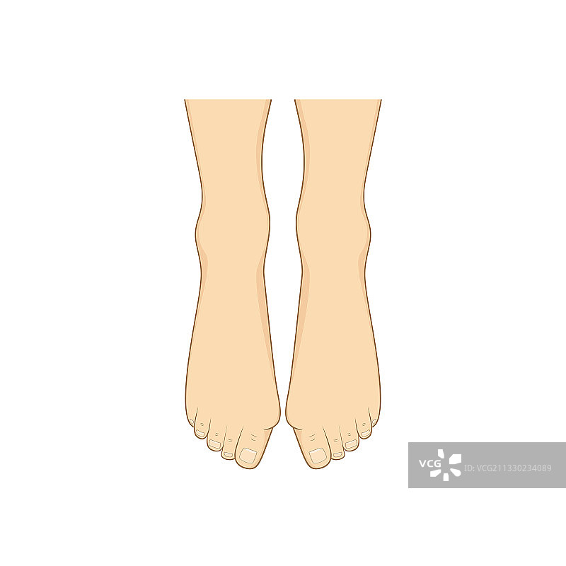 拇外翻图片素材