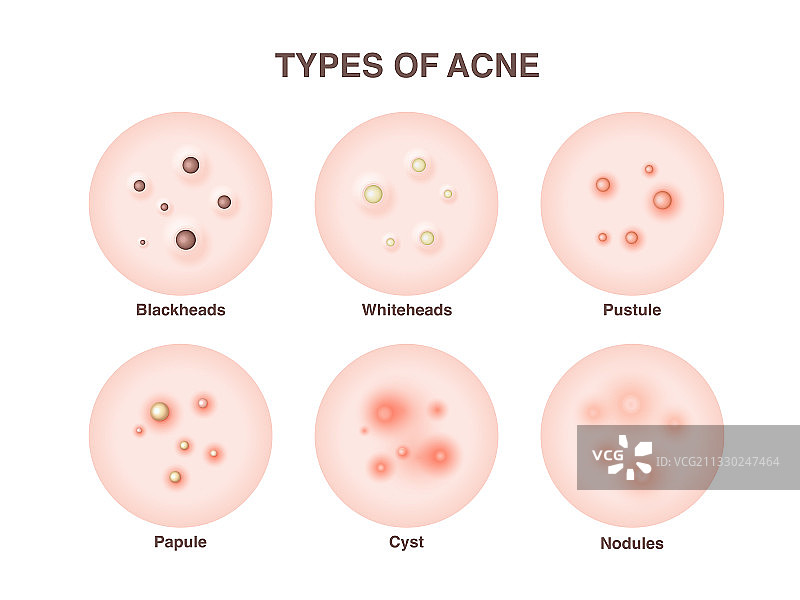 痤疮类型合集图片素材