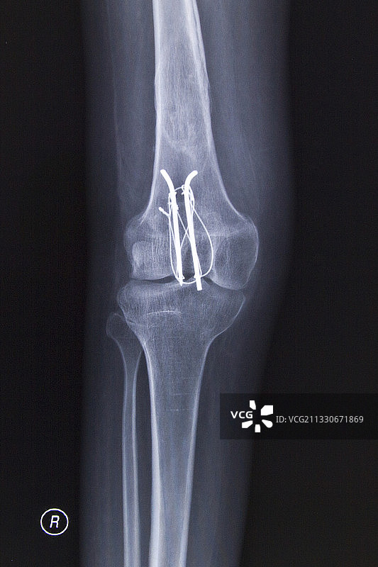 医学DR摄影X射线胶片影像图图片素材