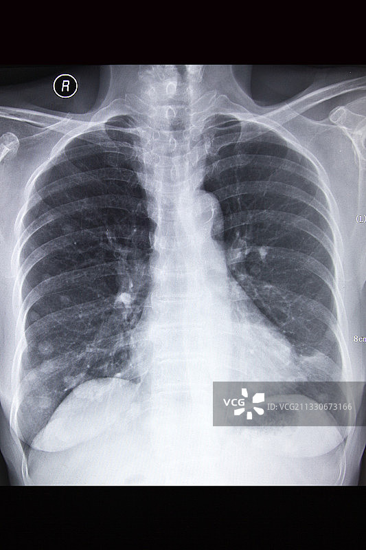 医学DR摄影X射线胶片影像图图片素材