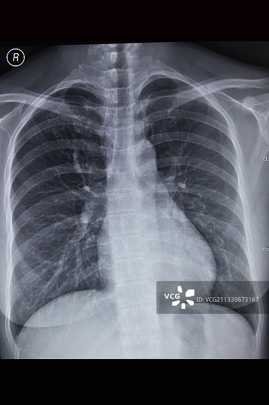 医学DR摄影X射线胶片影像图图片素材
