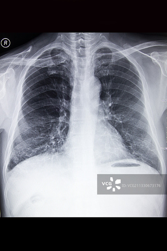 医学DR摄影X射线胶片影像图图片素材