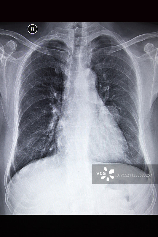 医学DR摄影X射线胶片影像图图片素材