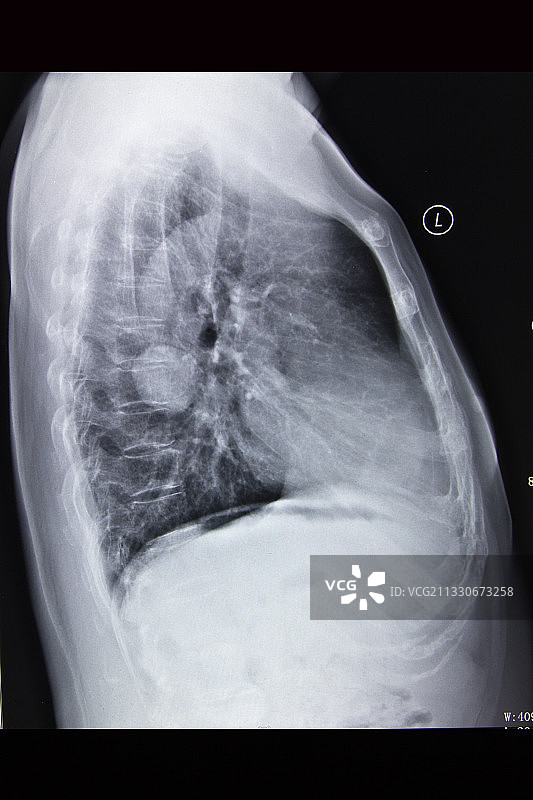 医学DR摄影X射线胶片影像图图片素材