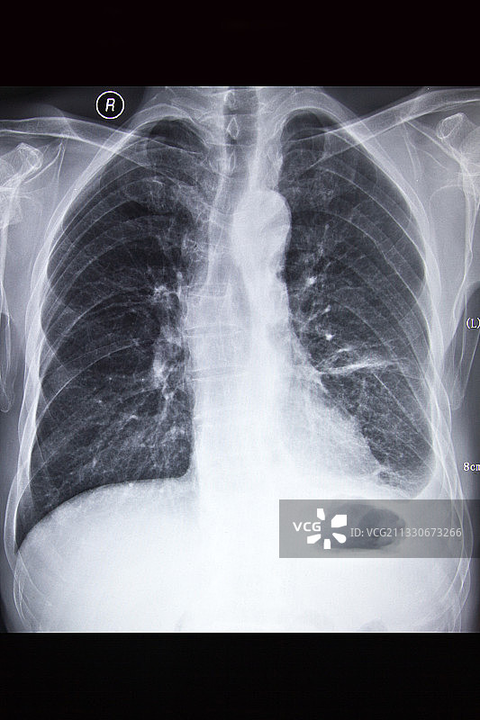 医学DR摄影X射线胶片影像图图片素材