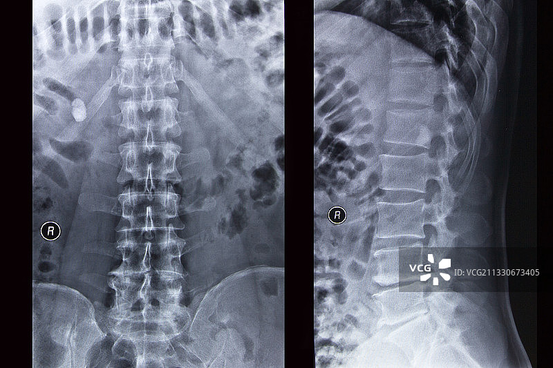 医学DR摄影X射线胶片影像图图片素材