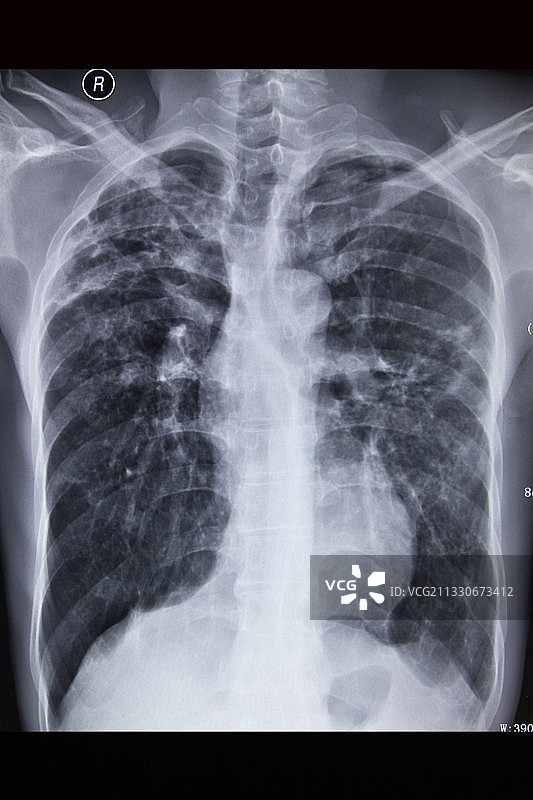 医学DR摄影X射线胶片影像图图片素材