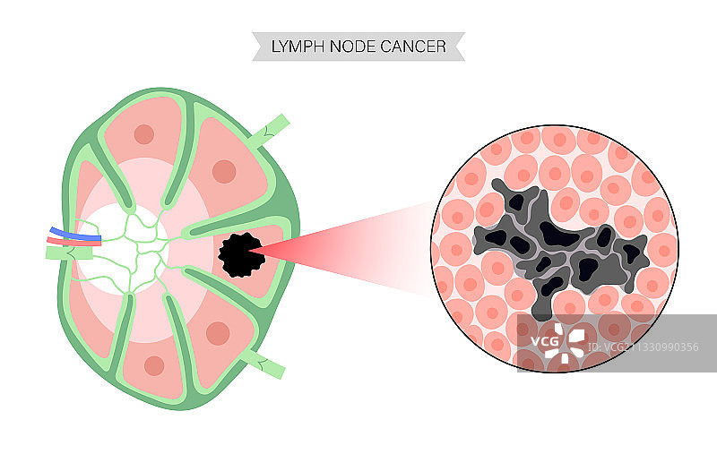 淋巴瘤癌症概念图片素材
