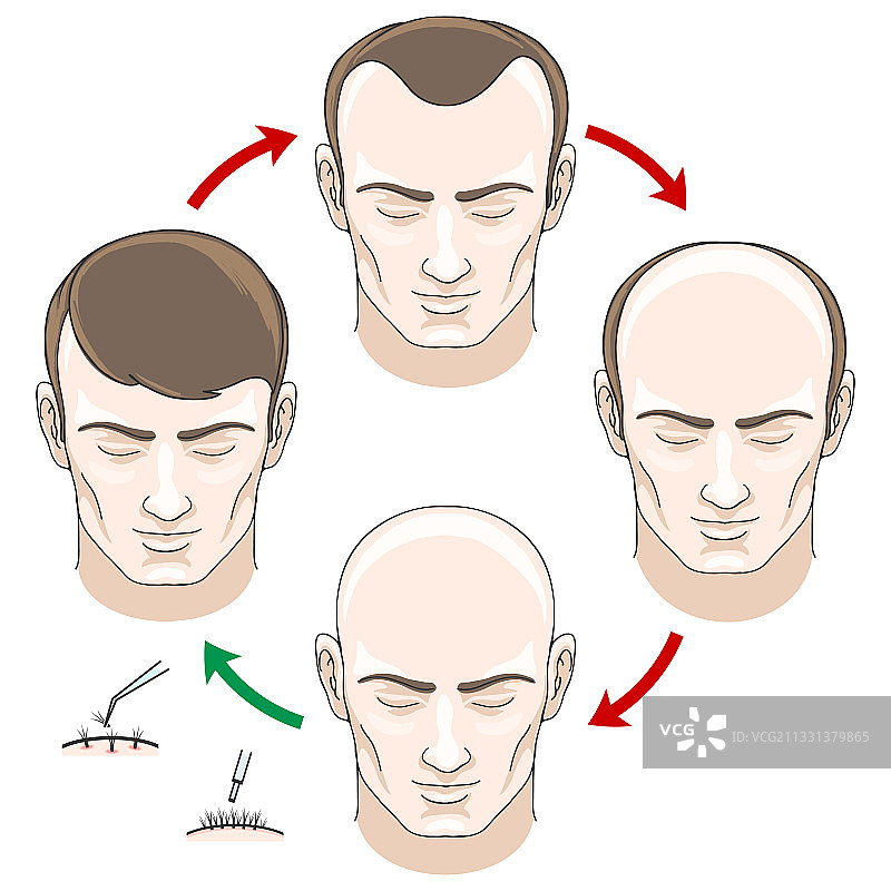 脱发治疗与移植阶段图片素材