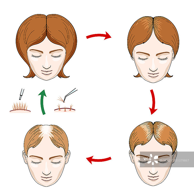 女性脱发和移植图标图片素材