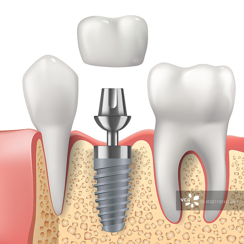 牙科种植牙写实图片素材