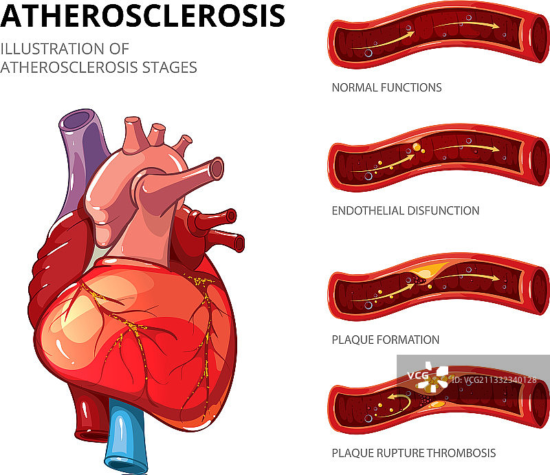 动脉粥样硬化纤维斑块形成图片素材