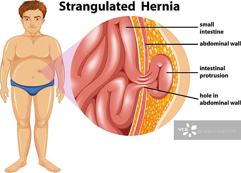 患有绞窄性疝气的男人图片素材