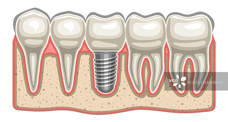 牙科植入体图片素材