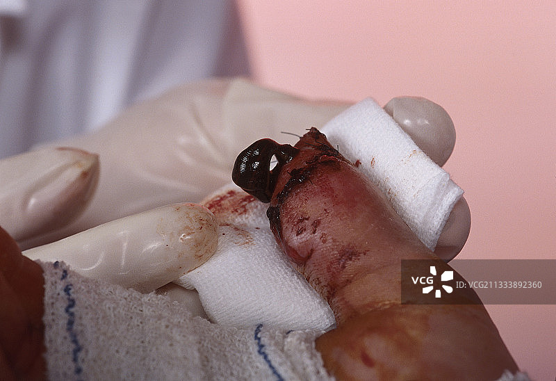 水蛭在手部显微外科手术中的应用图片素材