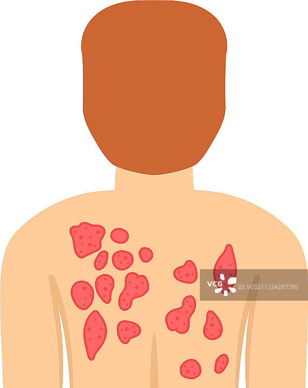 身体皮疹图片素材