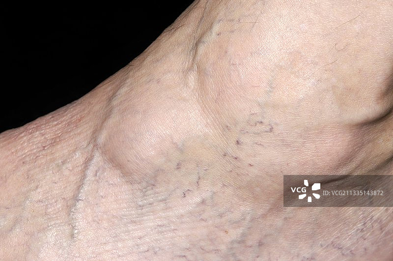 腱鞘囊肿图片素材