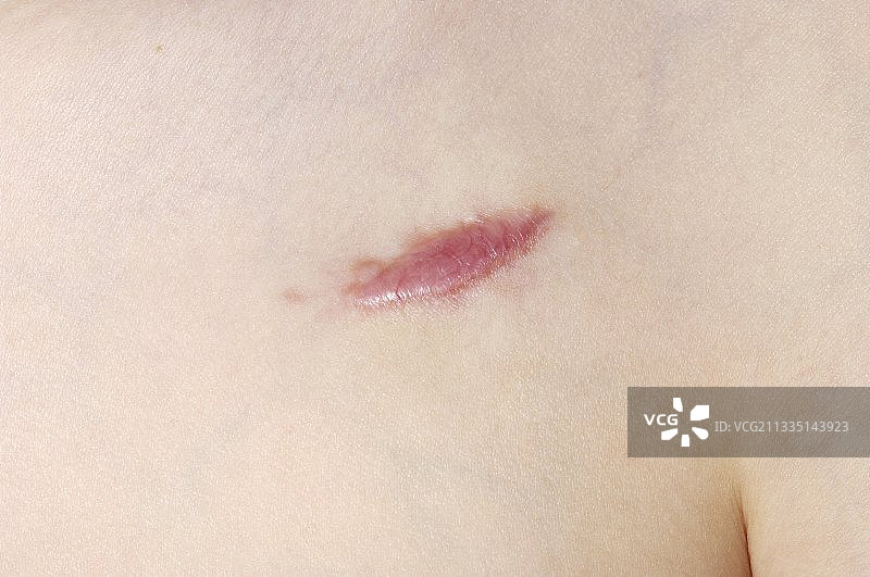 瘢痕疙瘩图片素材